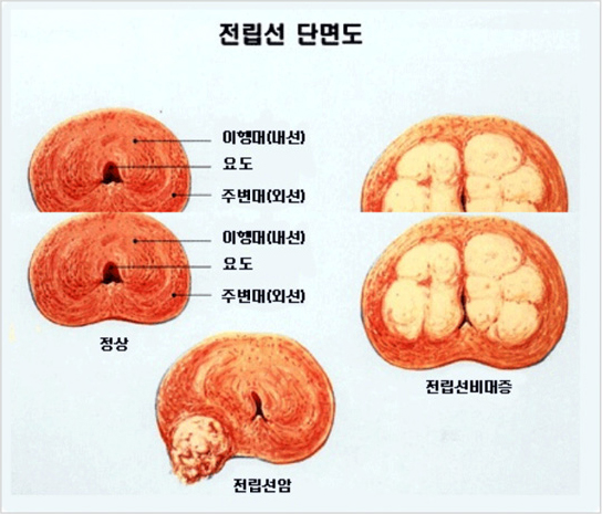 전립선 단면도